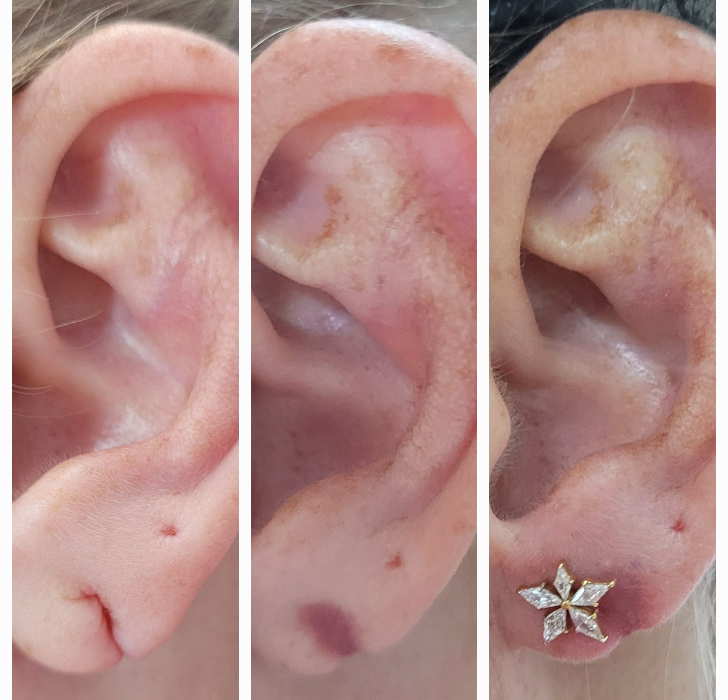 Lobuloplastia: antes e depois com nova perfuração